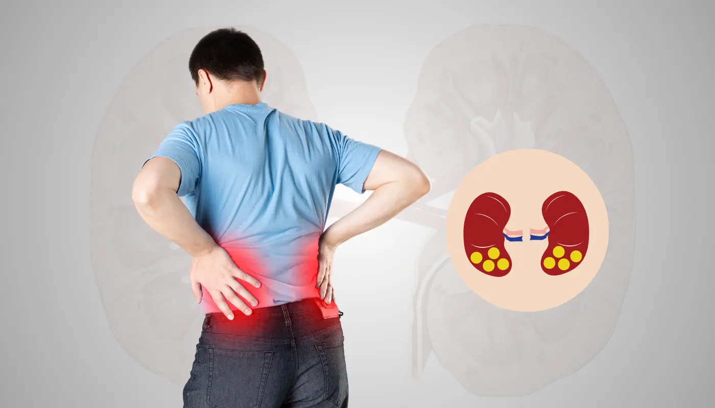 Kidney stone care clinic in nagole, Hyderabad - Dr Sourabh Reddy